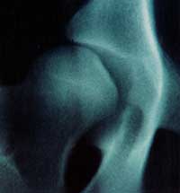 Right hip in close up. Minordegree of hip dysplasia (singlehip score:10)